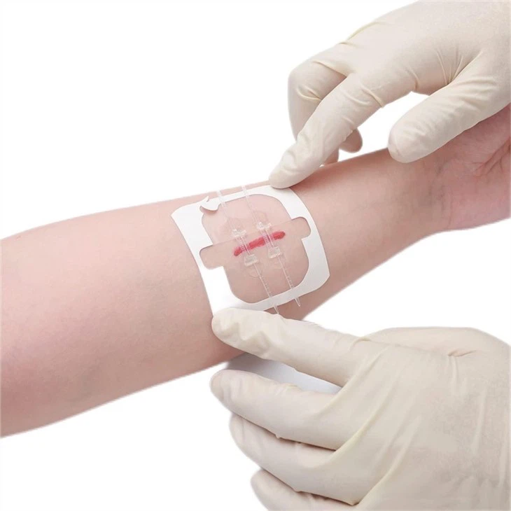 Wound Closure Device
